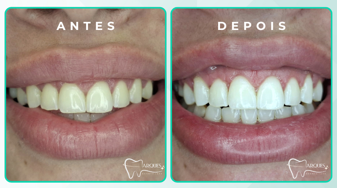 Dentes antes e depois do clareamento